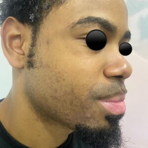 Tratamiento para acné y cicatrices de acné