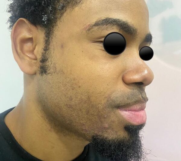 Tratamiento para acné y cicatrices de acné