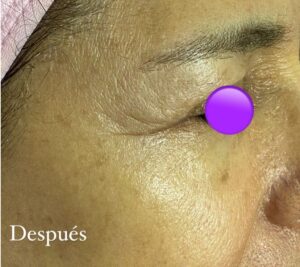 Rejuvenecimiento facial sin cirugía