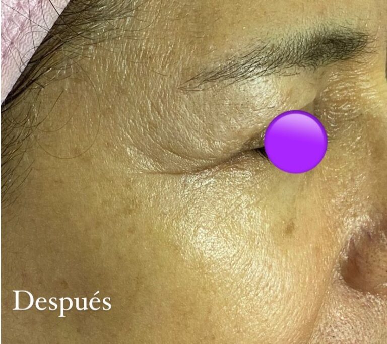 Rejuvenecimiento facial sin cirugía