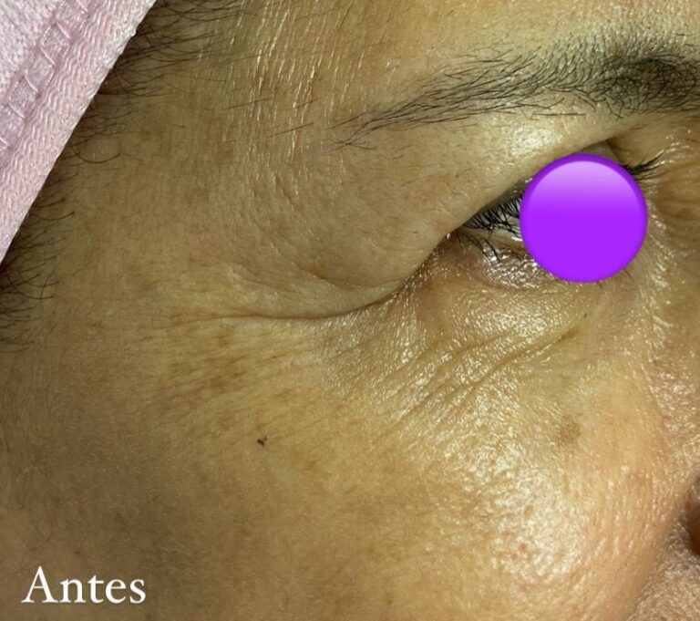 Rejuvenecimiento facial sin cirugía