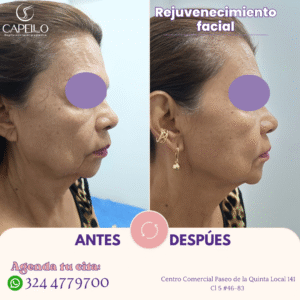 Rejuvenecimiento facial sin cirugía