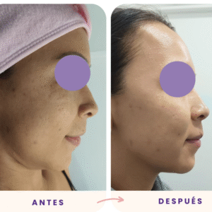 Limpieza facial gold