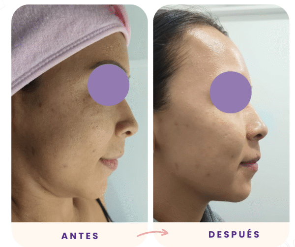 Limpieza facial gold