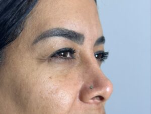 Rejuvenecimiento Facial sin cirugía en cali