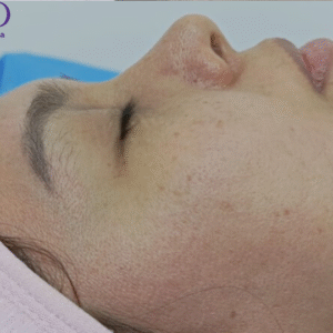 Despigmentación facial