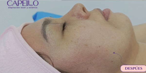 Despigmentación facial