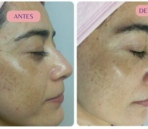 Despigmentación facial Cali