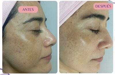 Despigmentación facial Cali