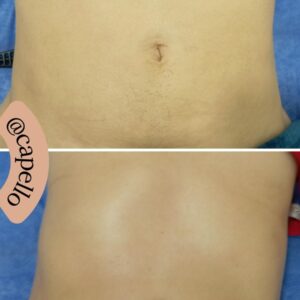 Recuperación postquirúrgica