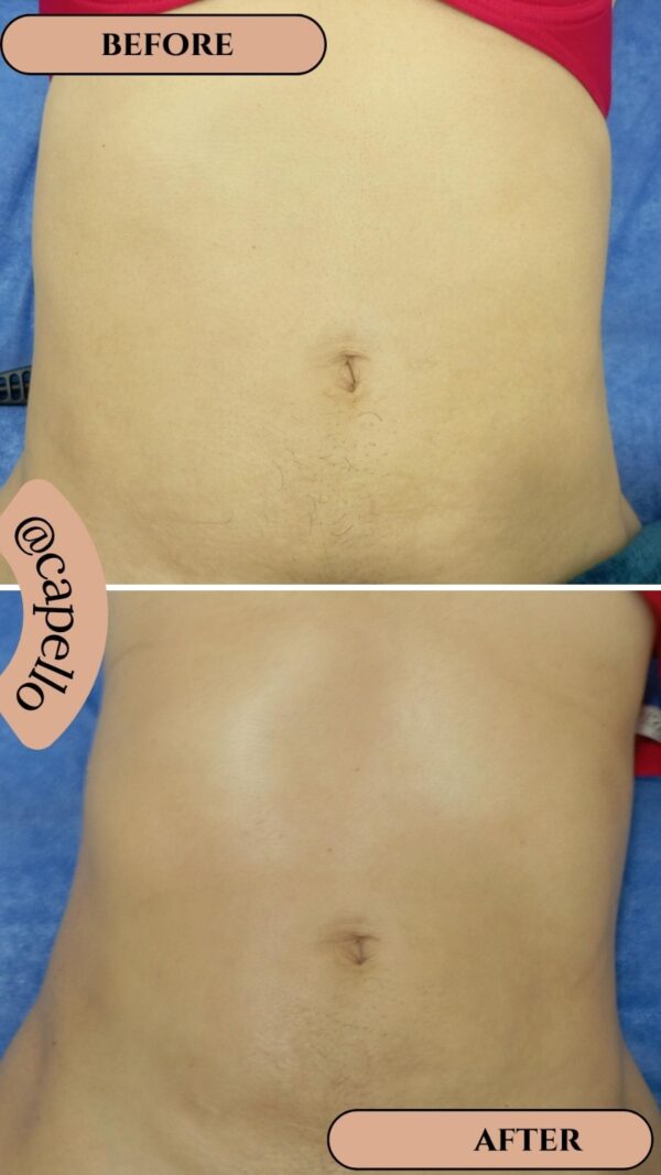 Recuperación postquirúrgica