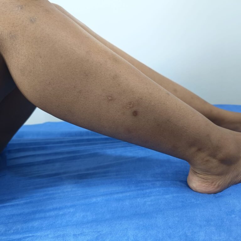 Despigmentación corporal