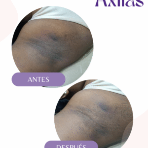 Despigmentación Corporal en Cali