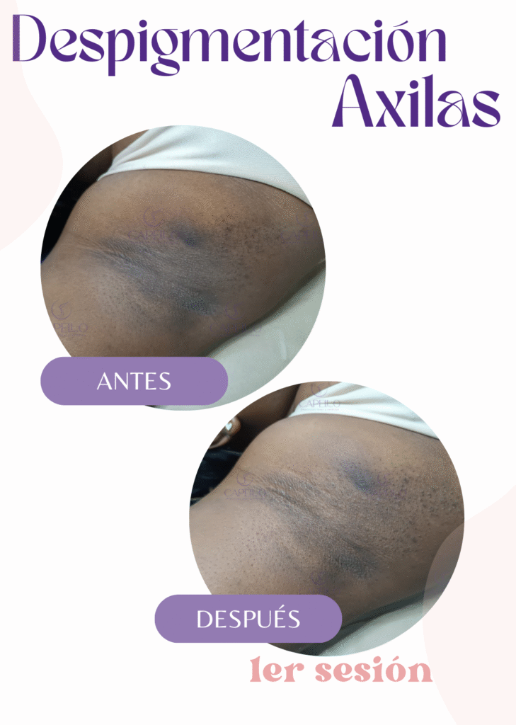 Despigmentación Corporal en Cali