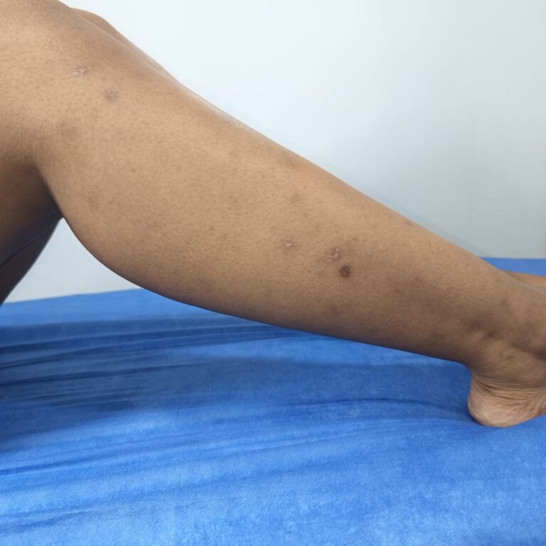 Despigmentación corporal