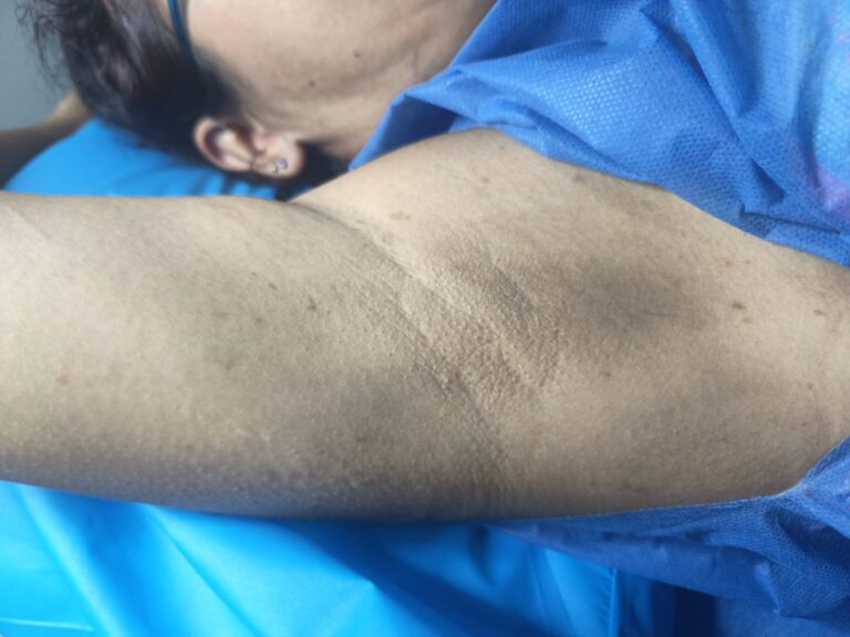 Despigmentación corporal