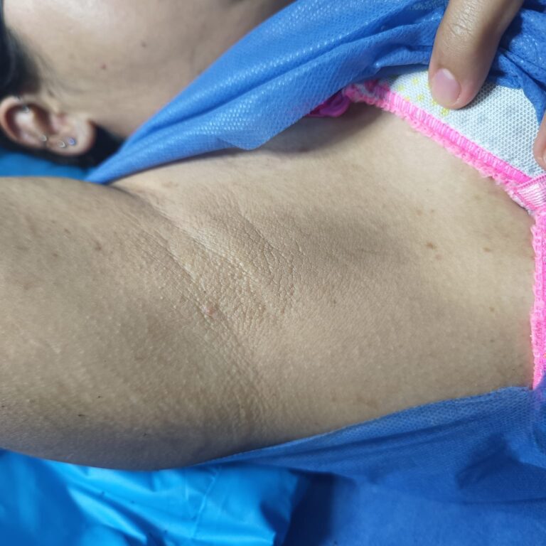 Despigmentación corporal