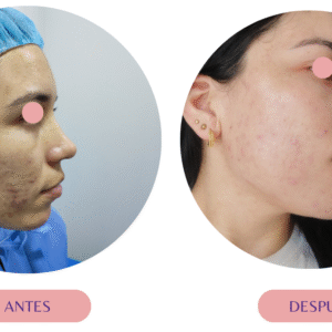 Tratamiento para acné