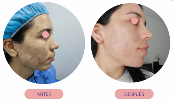 Tratamiento para acné