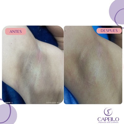 Despigmentación corporal Láser Cali
