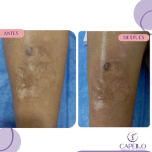 Tratamiento para Cicatrices con Exosomas