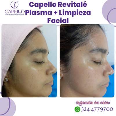 Capello Revitalé Plasma facial