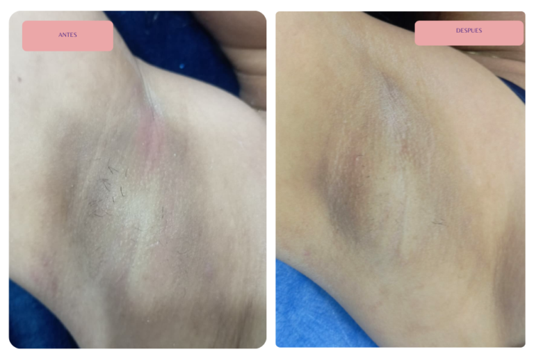 Despigmentación de axilas