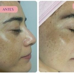 Despigmentación facial Cali
